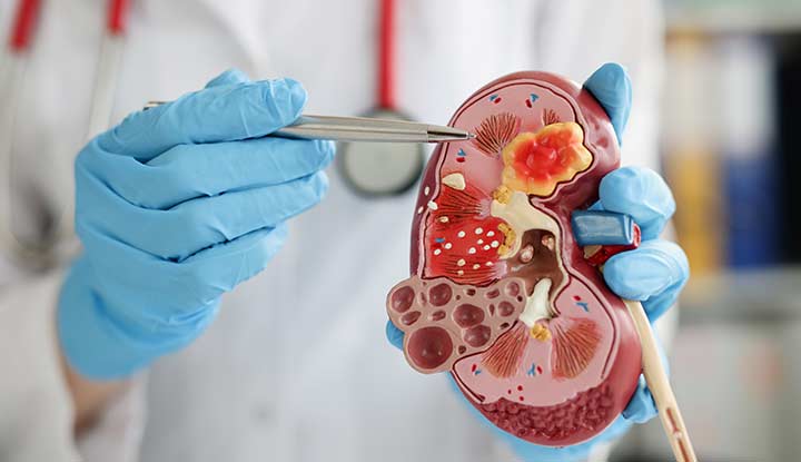 a nephrologist consulting with a patient.